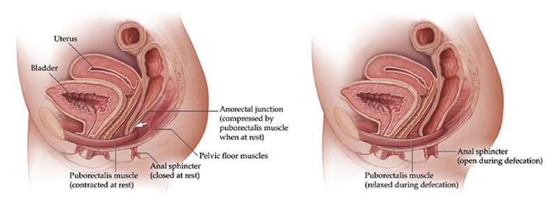 Chronic Constipation