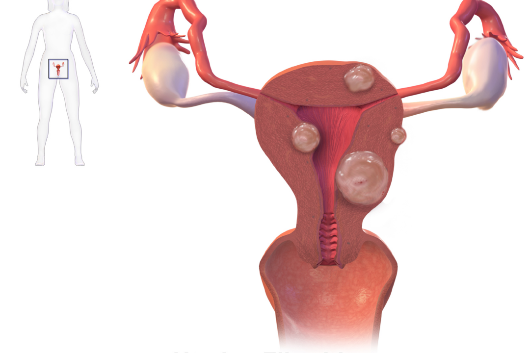 Uterine Fibroids