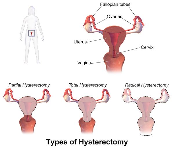 Surgery Types that can lead to Pain After A Hysterectomy