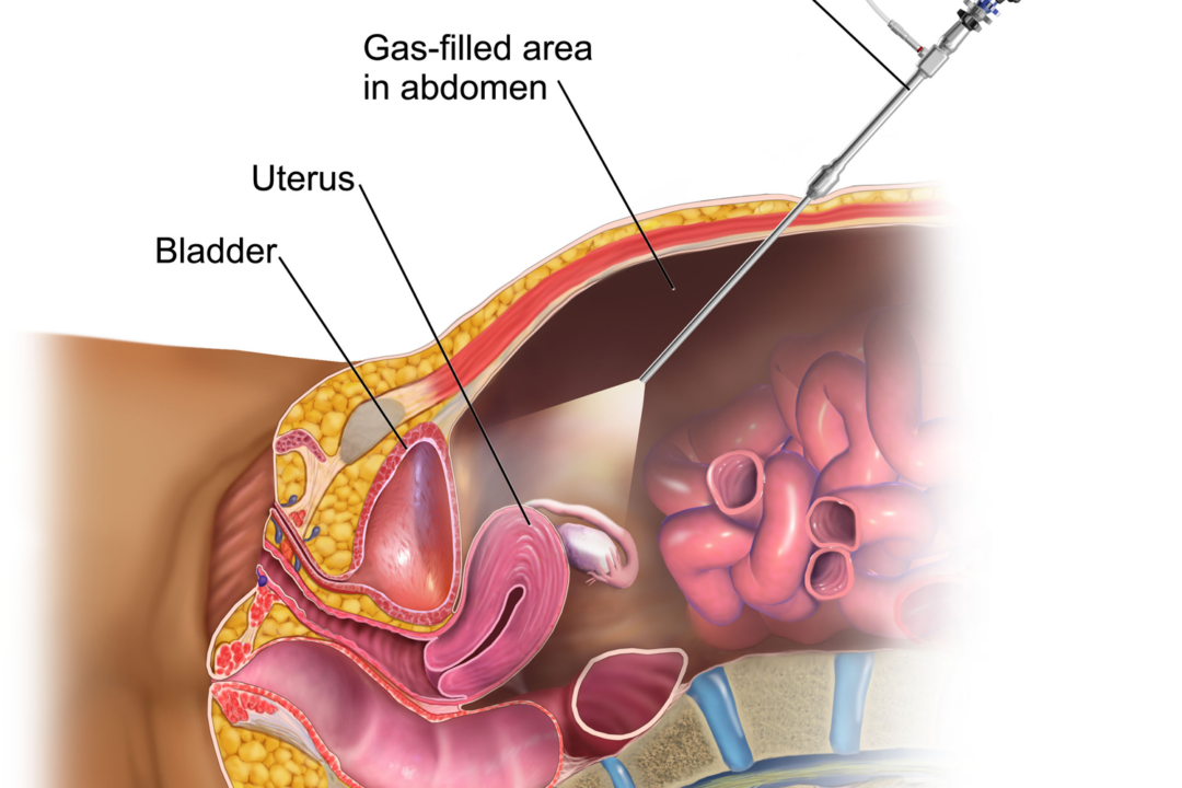 Endometriosis Surgery