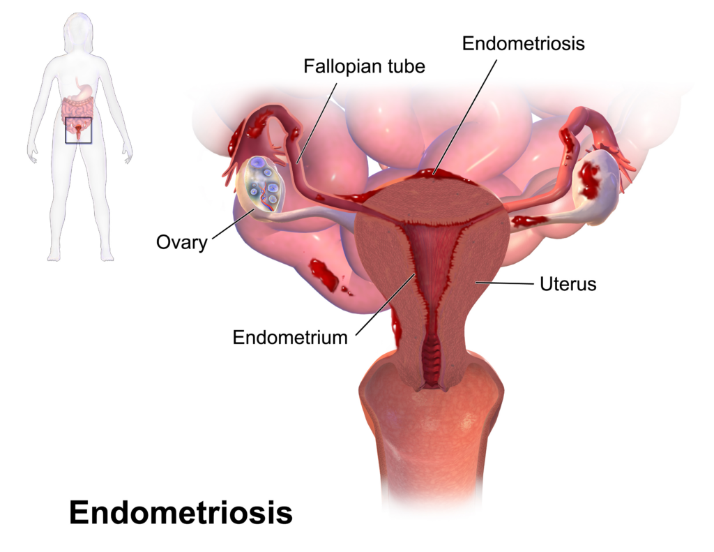 Image of a diagram showing endometriosis in the uterus.