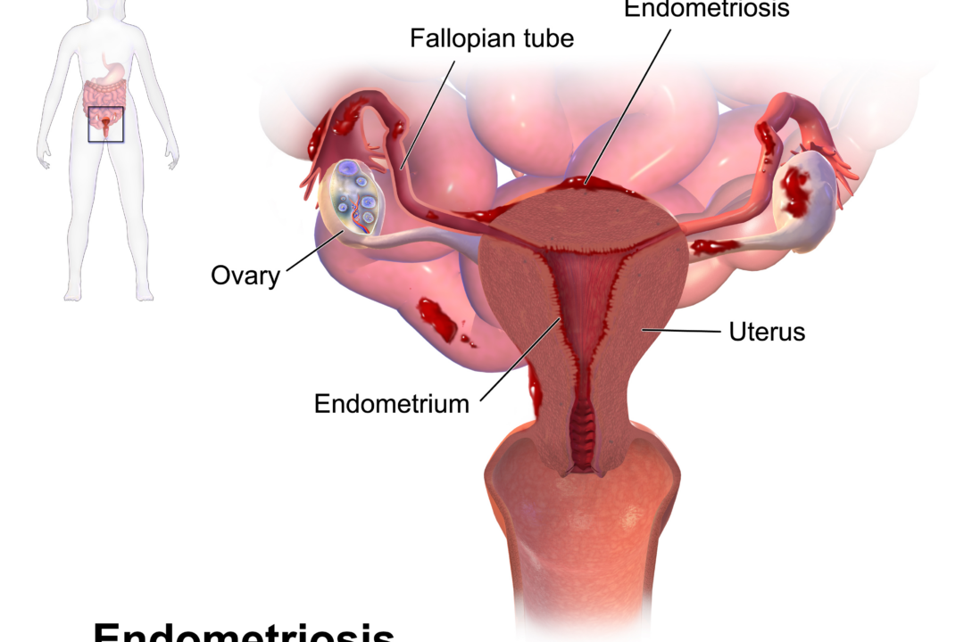 Endometriosis