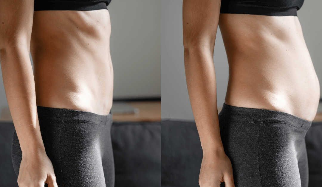 Diastasis Rectus Abdominis